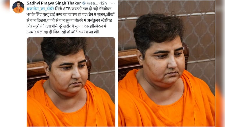 Had she remained alive... Sadhvi Pragya made big allegations against Congress by sharing the photo of her swollen face.